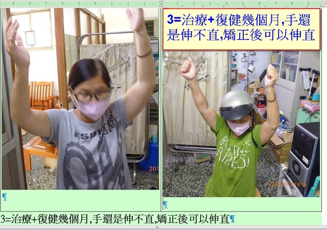 3=治療+復健幾個月,手還是伸不直,矯正後可以伸直_cr.jpg
